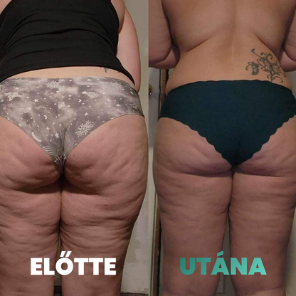 Skina SmoothSkin - Otthoni Megoldás Narancsbőr Ellen