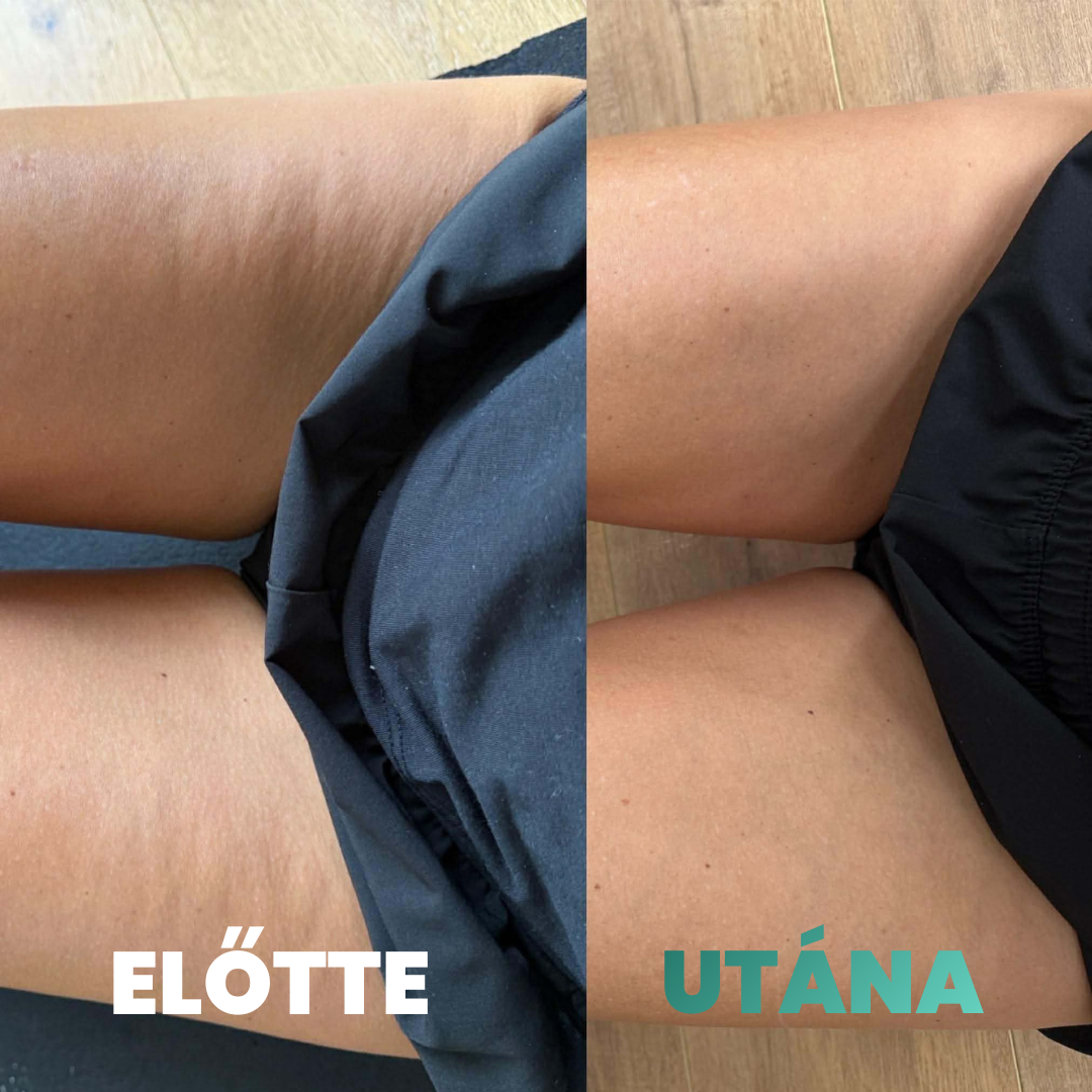 Skina SmoothSkin - Otthoni Megoldás Narancsbőr Ellen