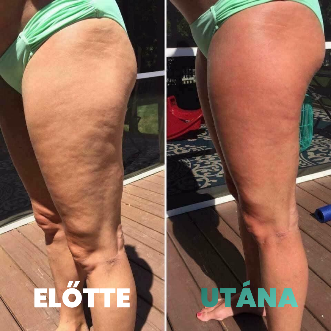 Skina SmoothSkin - Otthoni Megoldás Narancsbőr Ellen