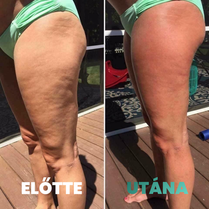 Skina SmoothSkin - Otthoni Megoldás Narancsbőr Ellen